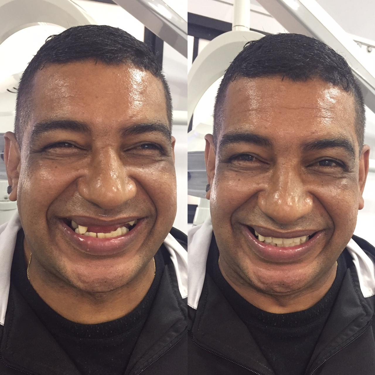 A imagem é um antes e depois do rosto de um homem de pele negra. Na imagem à esquerda ele está sorrindo e na parte superior está sem quatro dentes da frente. Na imagem à direita o mesmo homem está sorrindo mas a diferença é que há os quatro dentes que faltavam no sorriso.